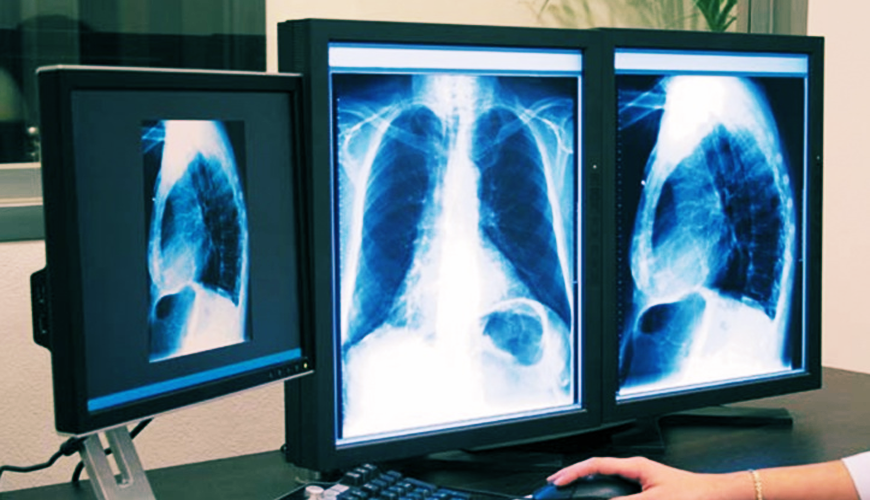 La tuberculose: le Maroc a enregistré 27.745 nouveaux en 2014