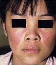 Lupus érythémateux disséminé
