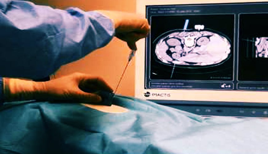 Un test respiratoire pour détecter la tuberculose