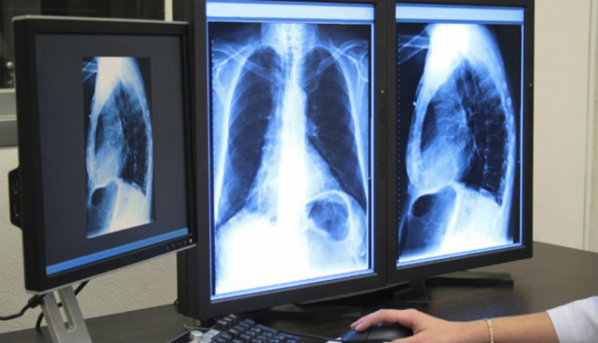 31.542 cas de tuberculose au Maroc durant l'année 2016