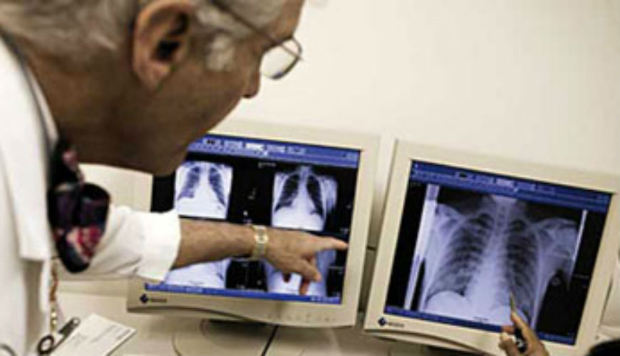 600 morts par an dus à la tuberculose au Maroc