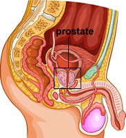 Cancer de la prostate