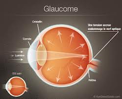 Glaucome