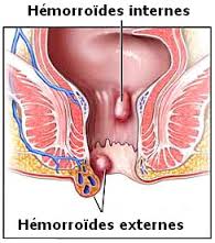 Hémorroïdes