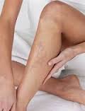 Insuffisance veineuse