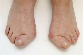 Hallux valgus