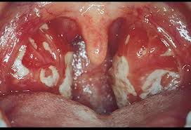 Mononucléose infectieuse