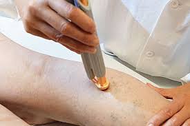 Varices des jambes