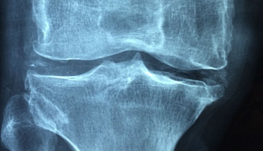 Réparation innovante du cartilage