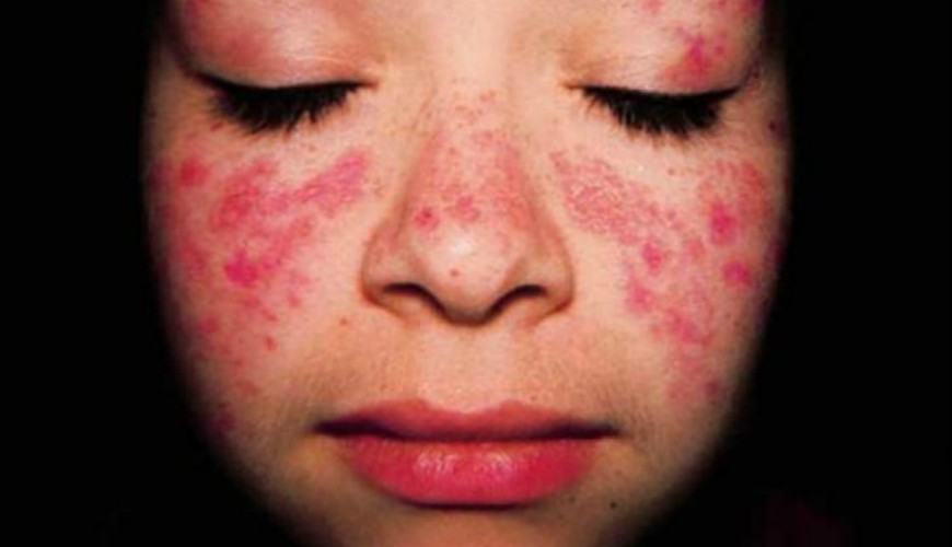 Lupus : une des premières causes de mortalité chez les femmes jeunes au Maroc