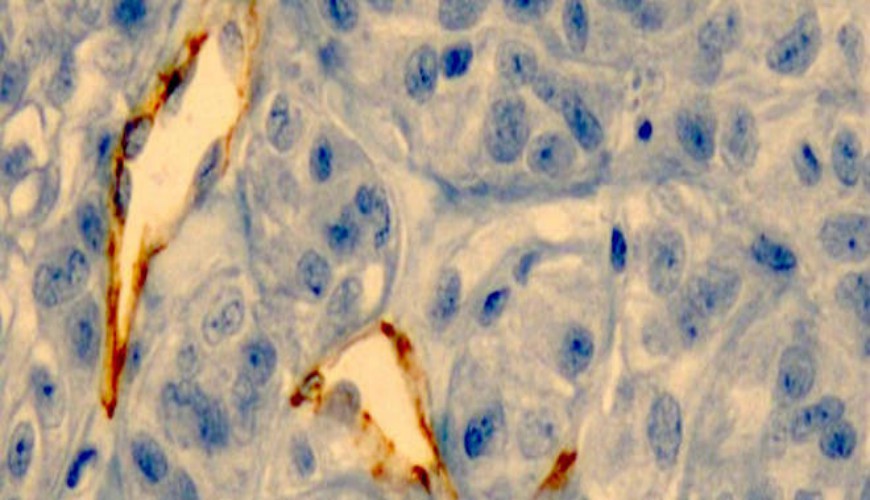 Bientôt des nano-aiguilles pour traiter le cancer de la peau