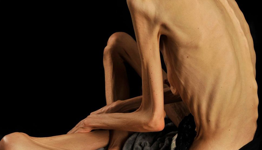 L'anorexie mentale