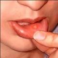 Aphtes